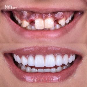 Fotografii înainte și după | Tratament dentar | Med Turkish