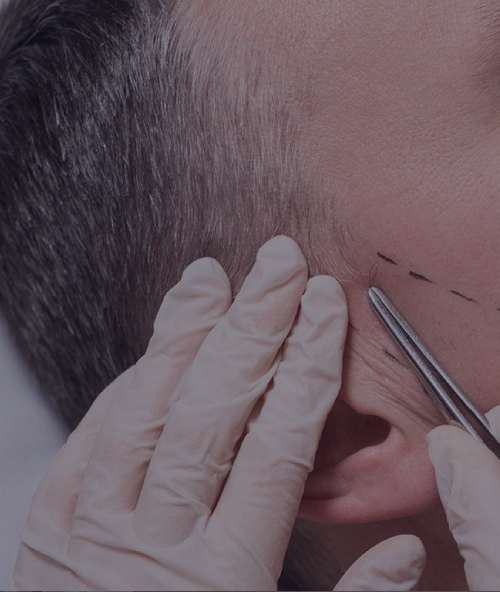 Best FUE Hair Transplant and hair restoration services in Turkey | MedTurkish