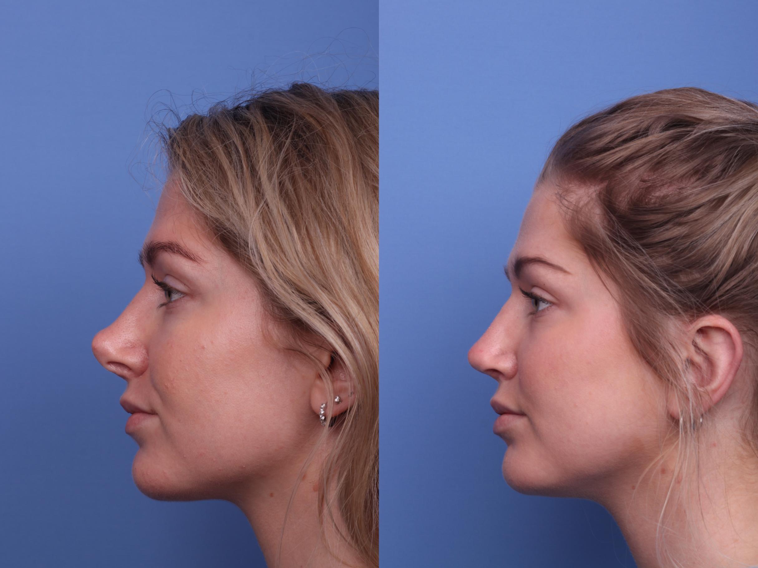 Non Surgical Rhinoplasty ( Nose Job ) | Med Turkish