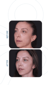 Fotografii înainte și după | Chirurgie plastica | Med Turkish