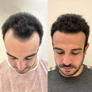 Before & After Photos | Hair Transplant