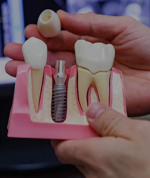 Serviciul de implant dentar în Turcia | Med Turkish